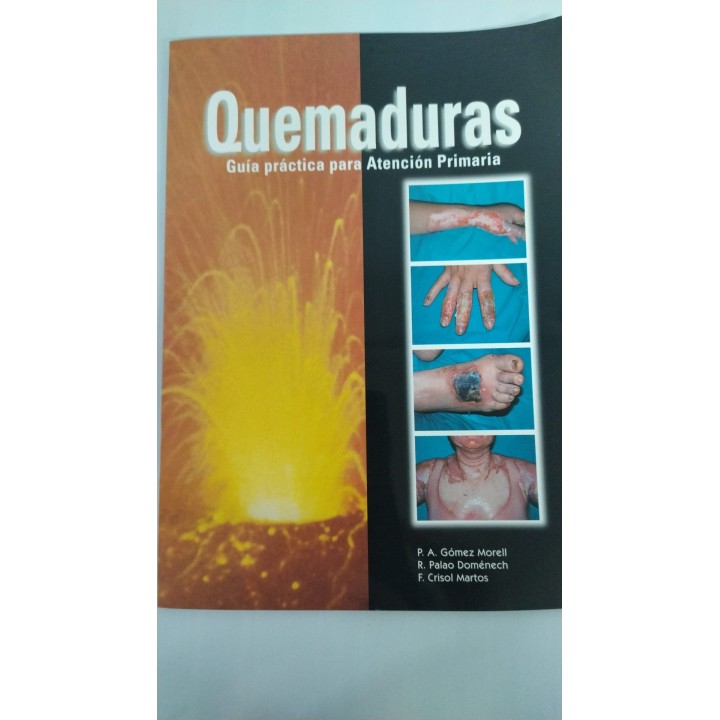 Quemaduras. Guia practica para Atencion Primaria