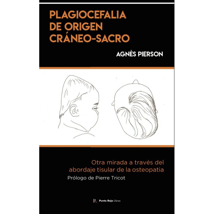 PLAGIOCEFALIA DE ORIGEN CRANEO SACRO