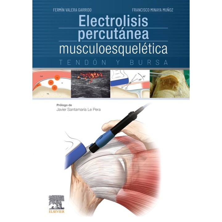ELECTROLISIS PERCUTANEA MUSCULOESQUELETICA. TENDON Y BURSA