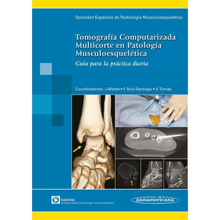 TOMOGRAFIA COMPUTARIZADA MULTICORTE EN PATOLOGIA MUSCULOESQU