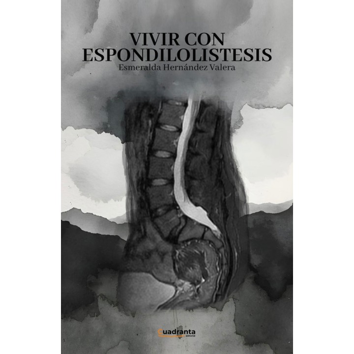 VIVIR CON ESPONDILOLISTESIS